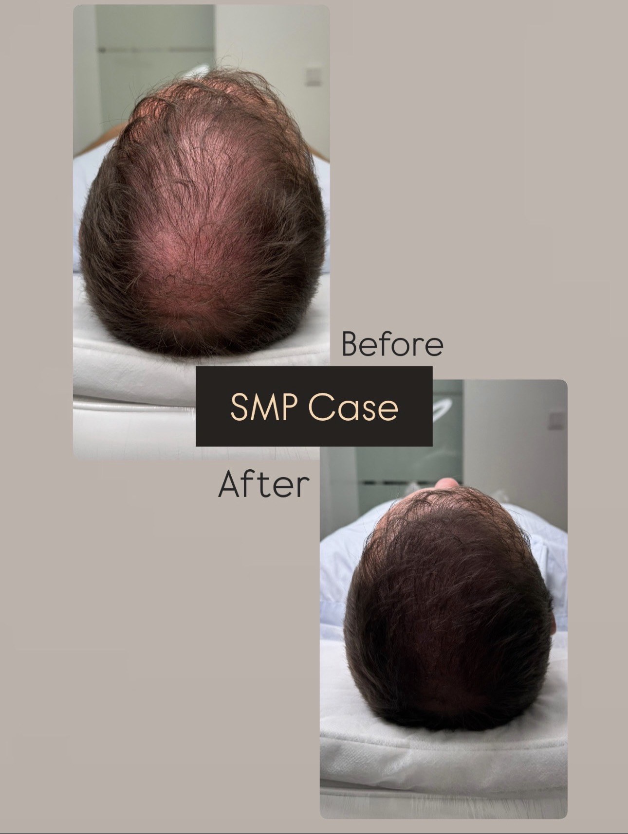 Scalp Micropigmentation bei einem Mann, vorher und nachher